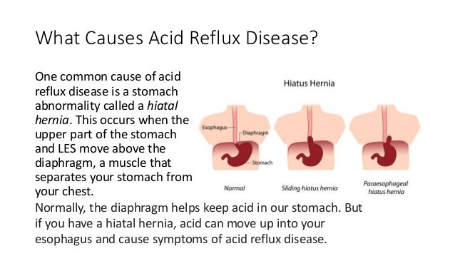 Acid reflux disease and cause