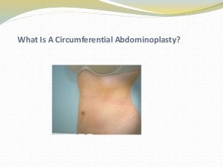 What Is A Circumferential Abdominoplasty?
 