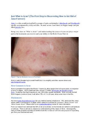 Just What is Acne? (The First Step to Discovering How to Get Rid of
Acne Forever)
Acne is a skin condition typified by groups of spots and pimples (whiteheads and blackheads)
usually accompanied by scaly red skin. In more severe cases there are bigger lumps and pus
filled pustules too.
Being very clear on ‘What is Acne?’ and understanding the causes of acne can play a major
part in the treatments you receive and your ability to Get Rid of Acne Forever.
Figure 1 Typical Moderate Acne on Forehead
Acne is rarely threatening to overall health but it is unsightly and often causes stress and
psychological trauma.
How Common is Acne
Acne is prevalent throughout the World. It seems to affect people from all races and is no respecter
of color or religion. At any particular time, around 17 million Americans are thought to have
Acne. Scaled up that figure equates to over 400 million people worldwide. More correctly termed
Acne Vulgaris (common Acne) it will affect 75% of 11 to 30 year old at some time in their life.
Disclaimers
No one at www.fixacneforever.com has any medical training whatsoever. This article and the views
shown within it are based on in-depth online research to answer the questions ‘What is Acne?’ and
‘What Causes Acne?’ Please refer to our medical disclaimer notice for more information.
From our research we estimate that 90% of all acne articles on the internet are written to sell products
or services. There is almost no research or understanding of the nature of Acne. Consequently,
many of these products are likely to be little more than ‘snake oil’ with the sole purpose of separating
you from your hard earned cash.
 