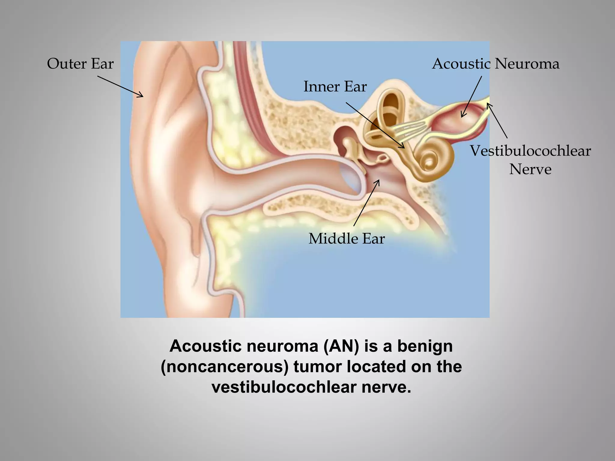 what-is-acoustic-neuroma-pptx