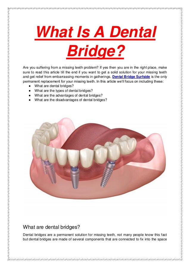 What Is A Dental
Bridge?
Are you suffering from a missing teeth problem? If yes then you are in the right place, make
sure to read this article till the end if you want to get a solid solution for your missing teeth
and get relief from embarrassing moments in gatherings. Dental Bridge Surfside is the only
permanent replacement for your missing teeth. In this article we’ll focus on including these:
● What are dental bridges?
● What are the types of dental bridges?
● What are the advantages of dental bridges?
● What are the disadvantages of dental bridges?
What are dental bridges?
Dental bridges are a permanent solution for missing teeth, not many people know this fact
but dental bridges are made of several components that are connected to fix into the space
 