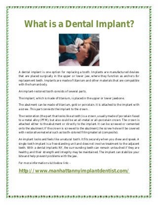 What is a Dental Implant?



A dental implant is one option for replacing a tooth. Implants are manufactured devices
that are placed surgically in the upper or lower jaw, where they function as anchors for
replacement teeth. Implants are made of titanium and other materials that are compatible
with the human body.

An implant-restored tooth consists of several parts.

The implant, which is made of titanium, is placed in the upper or lower jawbone.

The abutment can be made of titanium, gold or porcelain. It is attached to the implant with
a screw. This part connects the implant to the crown.

The restoration (the part that looks like a tooth) is a crown, usually made of porcelain fused
to a metal alloy (PFM), but also could be an all-metal or all-porcelain crown. The crown is
attached either to the abutment or directly to the implant. It can be screwed or cemented
onto the abutment. If the crown is screwed to the abutment, the screw hole will be covered
with restorative material such as tooth-colored filling material (composite).

An implant looks and feels like a natural tooth. It fits securely when you chew and speak. A
single-tooth implant is a free-standing unit and does not involve treatment to the adjacent
teeth. With a dental implants NY, the surrounding teeth can remain untouched if they are
healthy, and their strength and integrity may be maintained. The implant can stabilize your
bite and help prevent problems with the jaw.

For more information visit below link: -

http://www.manhattannyimplantdentist.com/
 
