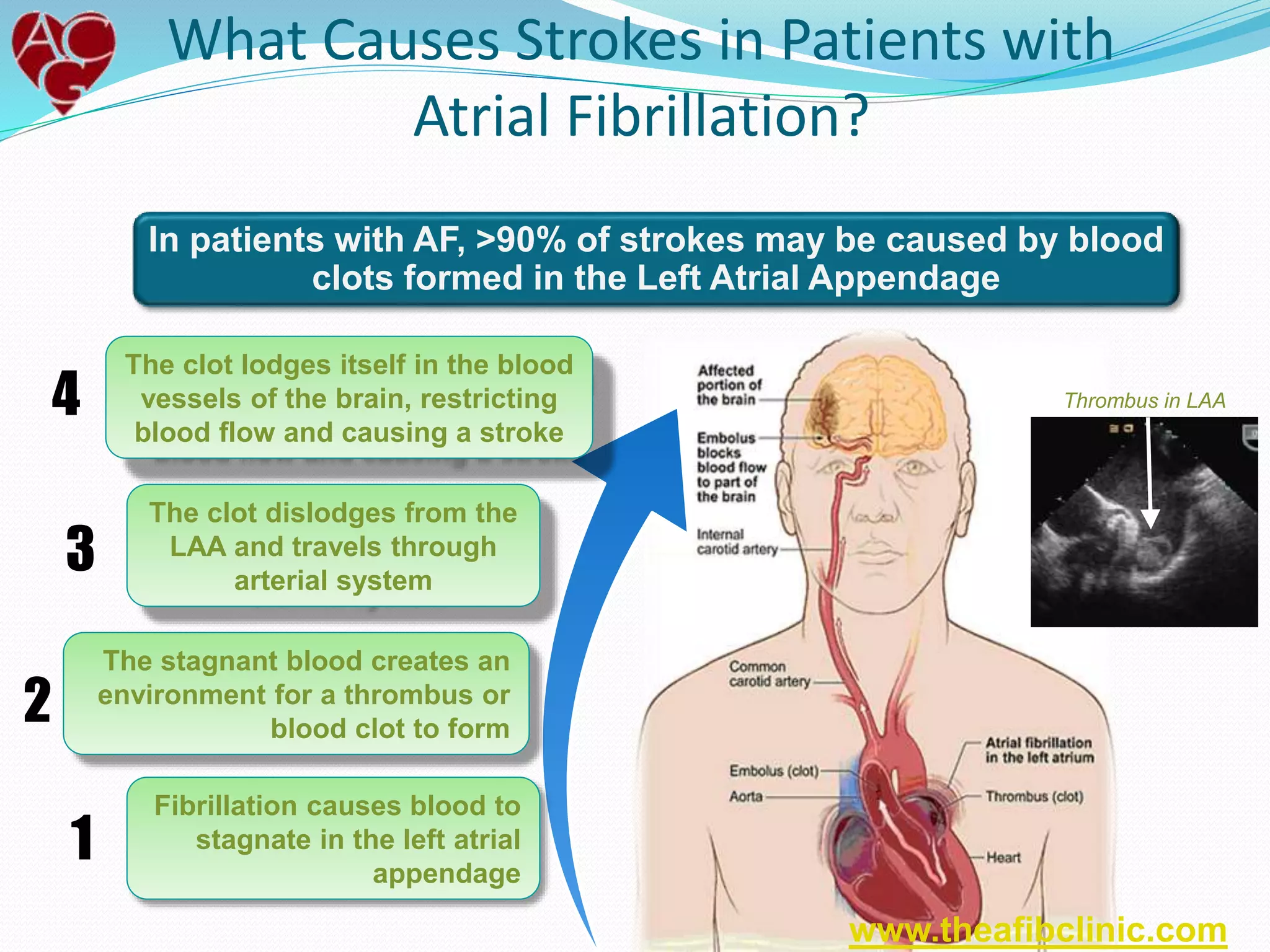 In patients with AF, >90% of strokes may be caused by blood
clots formed in the Left Atrial Appendage
Thrombus in LAA
The clot lodges itself in the blood
vessels of the brain, restricting
blood flow and causing a stroke
The clot dislodges from the
LAA and travels through
arterial system
The stagnant blood creates an
environment for a thrombus or
blood clot to form
Fibrillation causes blood to
stagnate in the left atrial
appendage
What Causes Strokes in Patients with
Atrial Fibrillation?
1
2
3
4
www.theafibclinic.com
 
