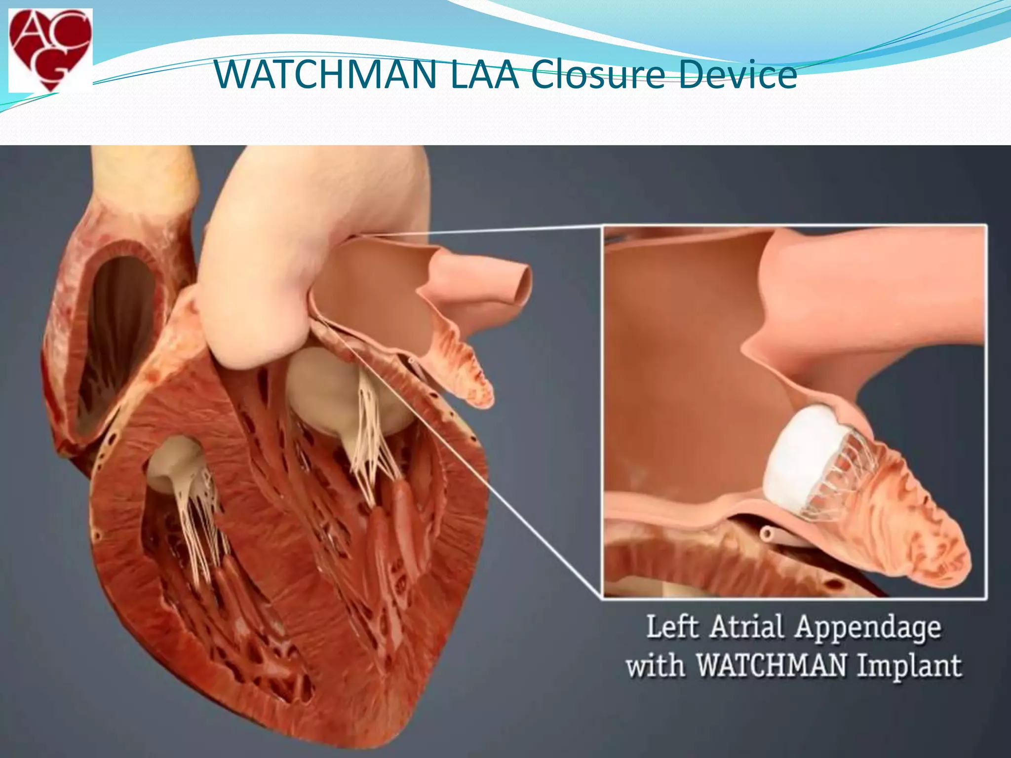 WATCHMAN LAA Closure Device
3000838-18
www.theafcenter.com
 