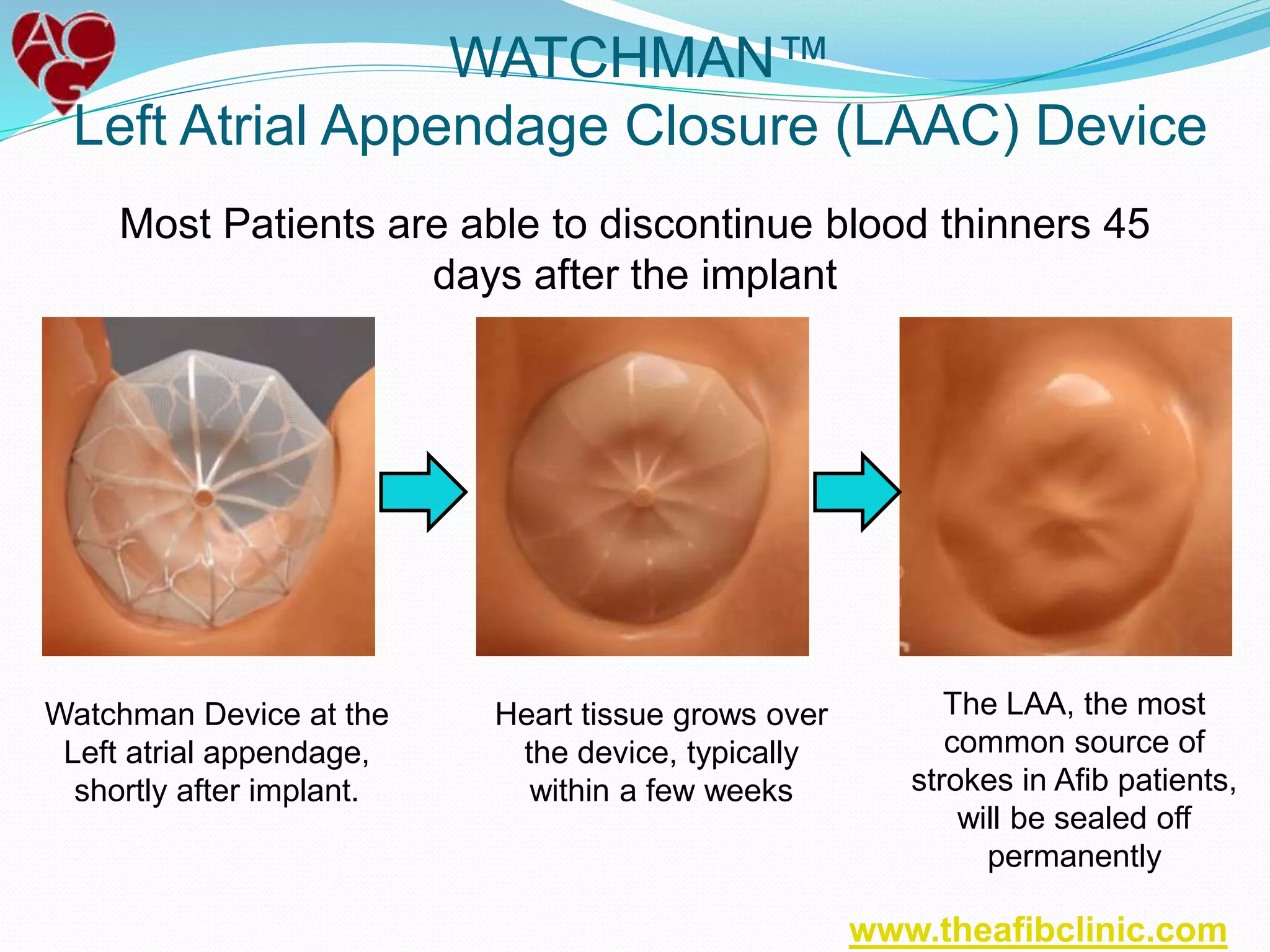 WATCHMAN™
Left Atrial Appendage Closure (LAAC) Device
Heart tissue grows over
the device, typically
within a few weeks
Most Patients are able to discontinue blood thinners 45
days after the implant
Watchman Device at the
Left atrial appendage,
shortly after implant.
The LAA, the most
common source of
strokes in Afib patients,
will be sealed off
permanently
www.theafibclinic.com
 