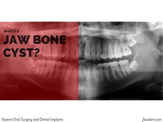 What is a Jaw Bone Cyst?