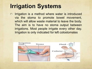 Irrigation Systems
Irrigation is a method where water is introduced
via the stoma to promote bowel movement,
which will allow waste material to leave the body.
The aim is to have no stoma output between
irrigations. Most people irrigate every other day.
Irrigation is only indicated for left colostomates
 