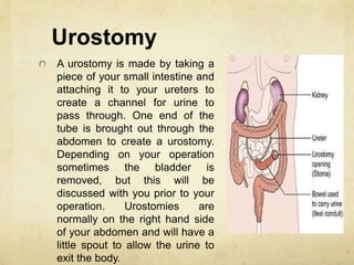 Urostomy
A urostomy is made by taking a
piece of your small intestine and
attaching it to your ureters to
create a channel for urine to
pass through. One end of the
tube is brought out through the
abdomen to create a urostomy.
Depending on your operation
sometimes the bladder is
removed, but this will be
discussed with you prior to your
operation. Urostomies are
normally on the right hand side
of your abdomen and will have a
little spout to allow the urine to
exit the body.
 
