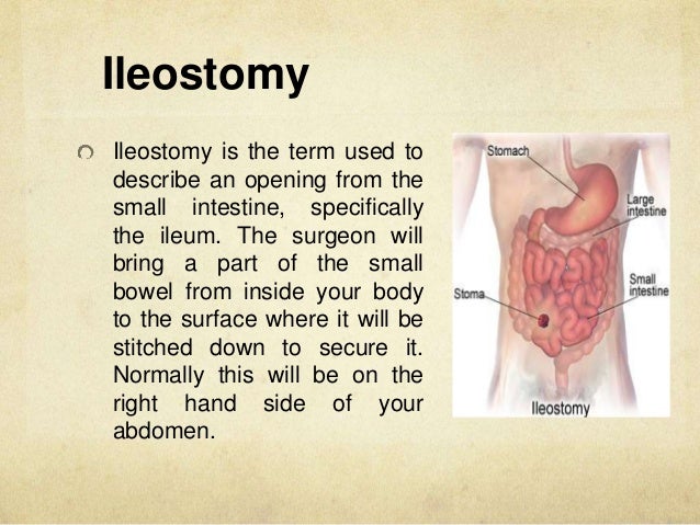 what is an ostomy