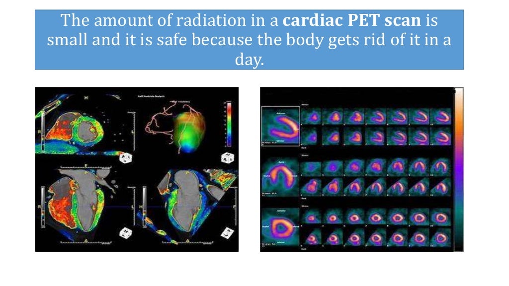 What is a pet scan