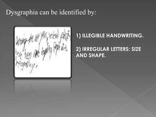 Dysgraphia can be identified by:


                        1) ILLEGIBLE HANDWRITING.

                        2) IRREGULAR LETTERS: SIZE
                        AND SHAPE.
 