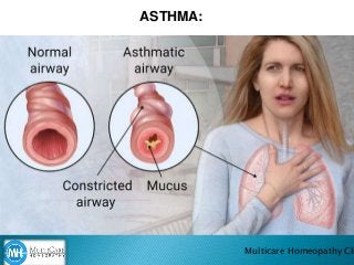 ASTHMA:
Multicare Homeopathy Cli
 