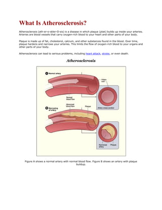What Is Atherosclerosis?
Atherosclerosis (ath-er-o-skler-O-sis) is a disease in which plaque (plak) builds up inside your arteries.
Arteries are blood vessels that carry oxygen-rich blood to your heart and other parts of your body.

Plaque is made up of fat, cholesterol, calcium, and other substances found in the blood. Over time,
plaque hardens and narrows your arteries. This limits the flow of oxygen-rich blood to your organs and
other parts of your body.

Atherosclerosis can lead to serious problems, including heart attack, stroke, or even death.


                                        Atherosclerosis




    Figure A shows a normal artery with normal blood flow. Figure B shows an artery with plaque
                                            buildup.
 