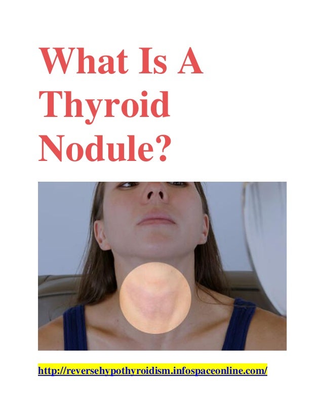 What is a thyroid nodule?