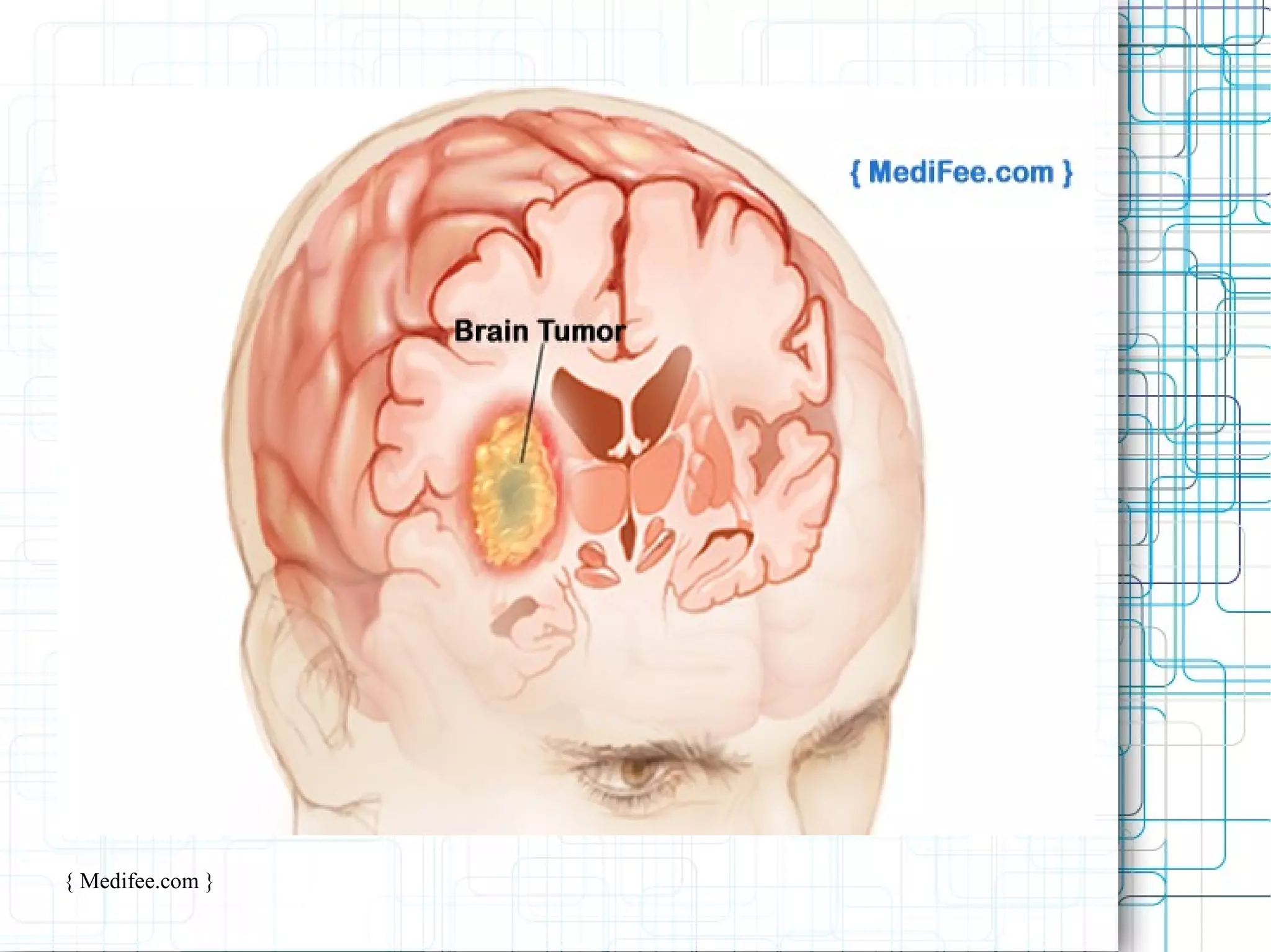 What is brain tumor? symptoms, causes and treatment | PPT