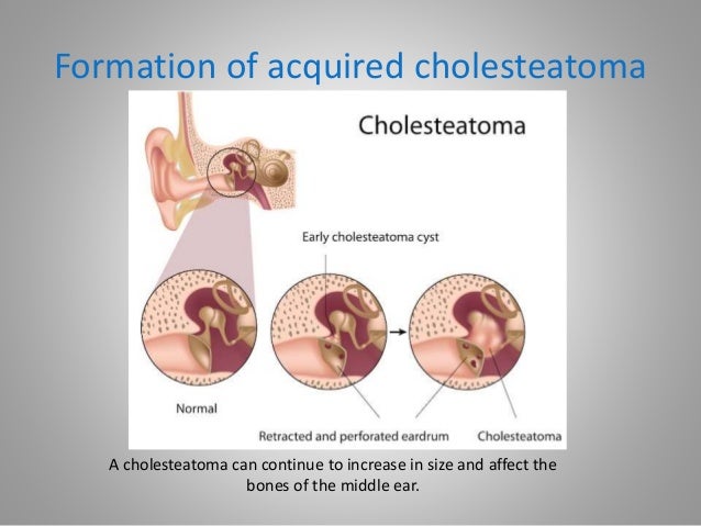 What is Cholesteatoma?
