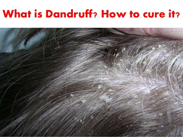 How To Rid Of Dandruff Naturally How To Rid Of Dandruff Naturally