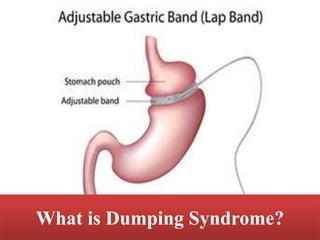 What is Dumping Syndrome?
 