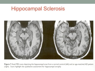 Hippocampal Sclerosis 
 