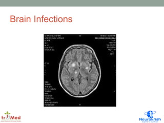 Brain Infections 
 