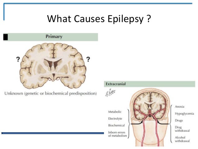 what causes seizures epilepsy a modern day perspective what causes seizures epilepsy a modern day perspective