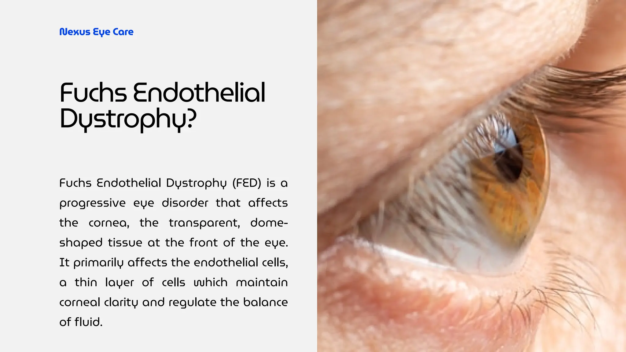 Understanding Fuchs Endothelial Dystrophy | PDF