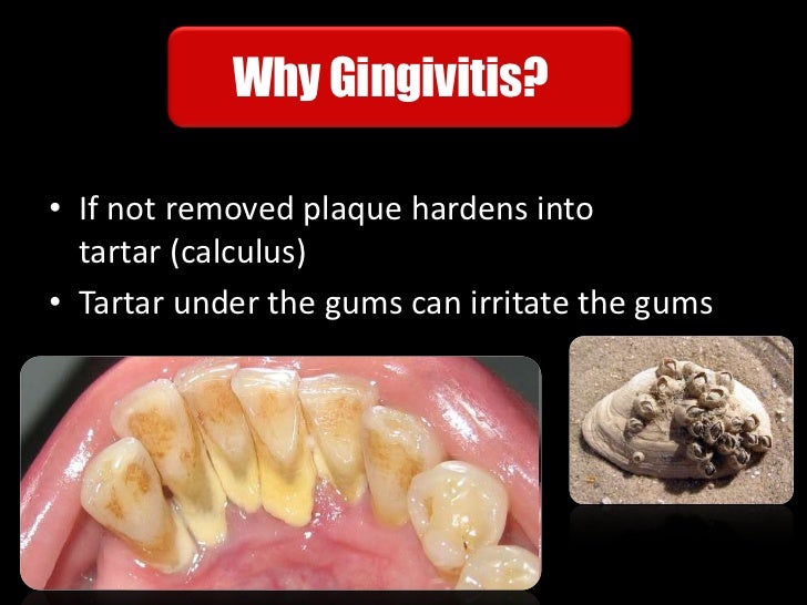 What is gum disease?