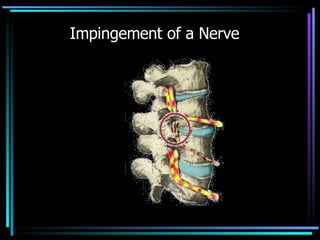 Impingement of a Nerve 