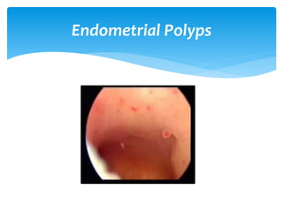 Endometrial Polyps