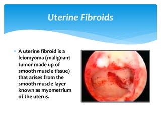 Uterine Fibroids
A uterine fibroid is a
leiomyoma (malignant
tumor made up of
smooth muscle tissue)
that arises from the
smooth muscle layer
known as myometrium
of the uterus.