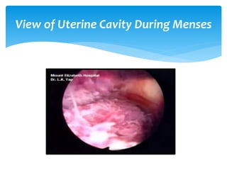 View of Uterine Cavity During Menses