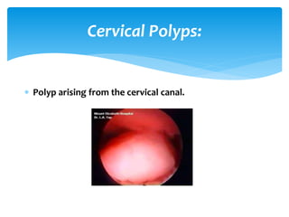 Cervical Polyps:
Polyp arising from the cervical canal.