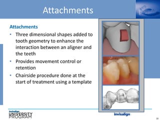 10
Attachments
Attachments
• Three dimensional shapes added to
tooth geometry to enhance the
interaction between an aligner and
the teeth
• Provides movement control or
retention
• Chairside procedure done at the
start of treatment using a template
 