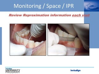 Monitoring / Space / IPR
Review Reproximation information each visit
 