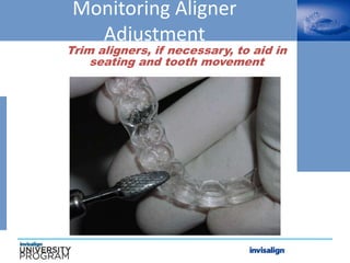 Monitoring Aligner
Adjustment
Trim aligners, if necessary, to aid in
seating and tooth movement
 
