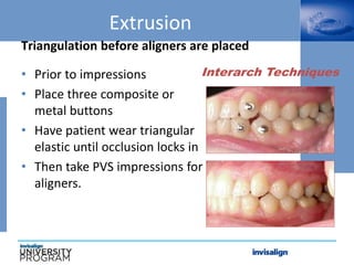 Interarch Techniques
Extrusion
• Prior to impressions
• Place three composite or
metal buttons
• Have patient wear triangular
elastic until occlusion locks in
• Then take PVS impressions for
aligners.
Triangulation before aligners are placed
 