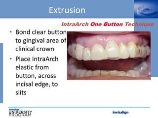 IntraArch One Button Technique
Extrusion
• Bond clear button
to gingival area of
clinical crown
• Place IntraArch
elastic from
button, across
incisal edge, to
slits
 