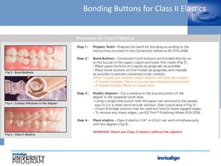 Bonding Buttons for Class II Elastics
 