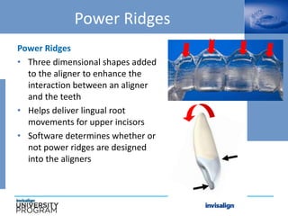 Power Ridges
Power Ridges
• Three dimensional shapes added
to the aligner to enhance the
interaction between an aligner
and the teeth
• Helps deliver lingual root
movements for upper incisors
• Software determines whether or
not power ridges are designed
into the aligners
 
