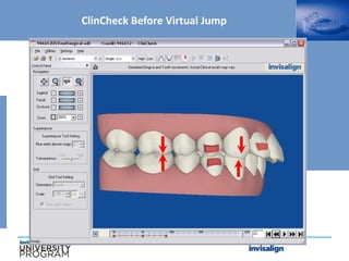 ClinCheck Before Virtual Jump
 