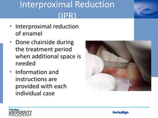 Interproximal Reduction
(IPR)
• Interproximal reduction
of enamel
• Done chairside during
the treatment period
when additional space is
needed
• Information and
instructions are
provided with each
individual case
 