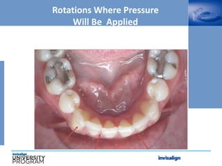 Rotations Where Pressure
Will Be Applied
 
