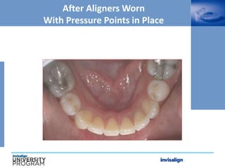 After Aligners Worn
With Pressure Points in Place
 