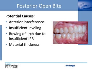 Posterior Open Bite
Potential Causes:
• Anterior interference
• Insufficient leveling
• Bowing of arch due to
insufficient IPR
• Material thickness
 