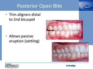 Posterior Open Bite
• Trim aligners distal
to 2nd bicuspid
• Allows passive
eruption (settling)
 