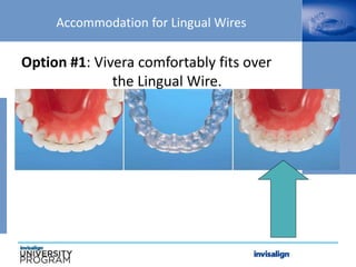 Accommodation for Lingual Wires
Option #1: Vivera comfortably fits over
the Lingual Wire.
 