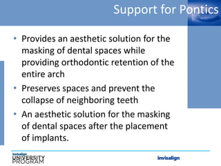 Support for Pontics
• Provides an aesthetic solution for the
masking of dental spaces while
providing orthodontic retention of the
entire arch
• Preserves spaces and prevent the
collapse of neighboring teeth
• An aesthetic solution for the masking
of dental spaces after the placement
of implants.
 
