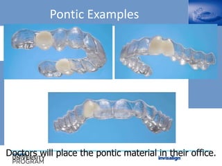 Pontic Examples
Doctors will place the pontic material in their office.
 