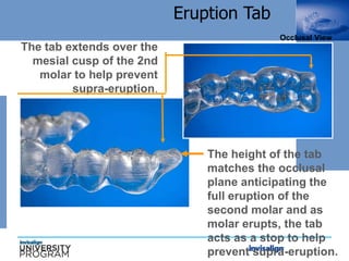 The tab extends over the
mesial cusp of the 2nd
molar to help prevent
supra-eruption.
Occlusal View
Eruption Tab
The height of the tab
matches the occlusal
plane anticipating the
full eruption of the
second molar and as
molar erupts, the tab
acts as a stop to help
prevent supra-eruption.
 