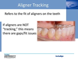 Aligner Tracking
Refers to the fit of aligners on the teeth
If aligners are NOT
“tracking,” this means
there are gaps/fit issues
 